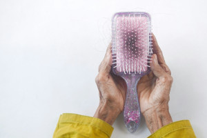Απώλεια μαλλιών και αλωπεκία: Αυτά είναι τα συμπτώματα που πρέπει να σας ανησυχούν