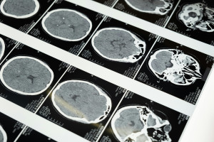 Πρώιμο Αλτσχάιμερ: 5 αλλαγές που βελτιώνουν τη λειτουργία του εγκεφάλου