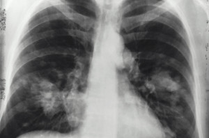 Καρκίνος του πνεύμονα: Αυτά είναι τα κύρια προειδοποιητικά σημάδια
